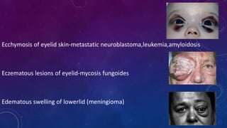 Ecchymosis of eyelid skin-metastatic neuroblastoma,leukemia,amyloidosis
Eczematous lesions of eyelid-mycosis fungoides
Edematous swelling of lowerlid (meningioma)
 
