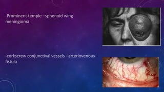 -Prominent temple –sphenoid wing
meningioma
-corkscrew conjunctival vessels –arteriovenous
fistula
 