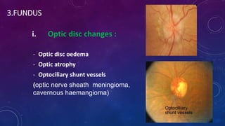 3.FUNDUS
i. Optic disc changes :
- Optic disc oedema
- Optic atrophy
- Optociliary shunt vessels
(optic nerve sheath meningioma,
cavernous haemangioma)
 