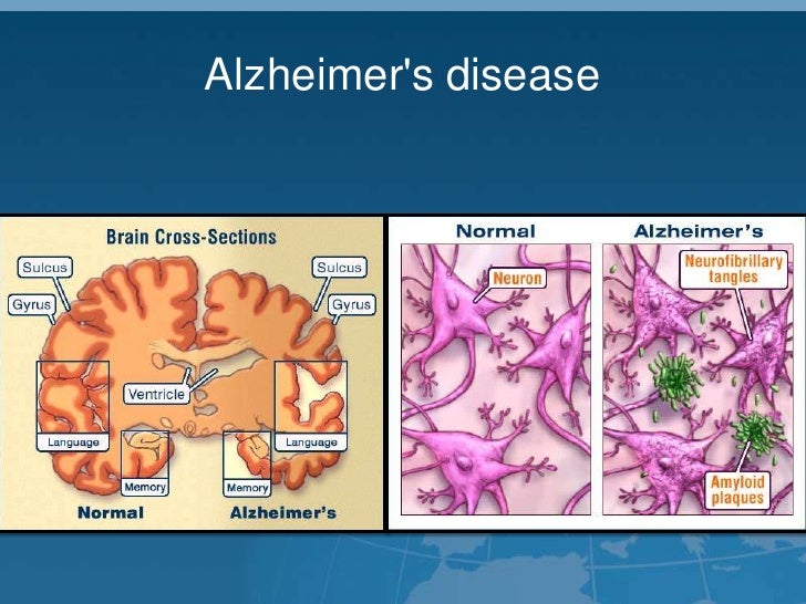 Alzheimer's and Parkinson's disease common cause