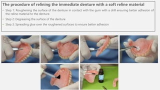 The procedure of relining the immediate denture with a soft reline material
• Step 1: Roughening the surface of the denture in contact with the gum with a drill ensuring better adhesion of
the reline material to the denture.
• Step 2: Degreasing the surface of the denture
• Step 3: Spreading glue over the roughened surfaces to ensure better adhesion
 