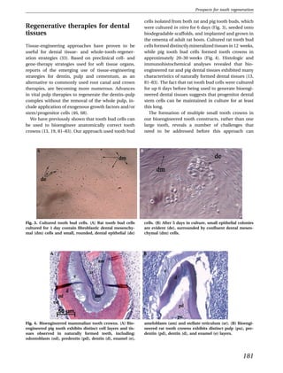 Prospects for tooth regeneration

                                                              cells isolated from both rat and pig tooth buds, which
Regenerative therapies for dental                             were cultured in vitro for 6 days (Fig. 3), seeded onto
tissues                                                       biodegradable scaffolds, and implanted and grown in
                                                              the omenta of adult rat hosts. Cultured rat tooth bud
Tissue-engineering approaches have proven to be               cells formed distinctly mineralized tissues in 12 weeks,
useful for dental tissue- and whole-tooth-regener-            while pig tooth bud cells formed tooth crowns in
ation strategies (33). Based on preclinical cell- and         approximately 20–30 weeks (Fig. 4). Histologic and
gene-therapy strategies used for soft tissue organs,          immunohistochemical analyses revealed that bio-
reports of the emerging use of tissue-engineering             engineered rat and pig dental tissues exhibited many
strategies for dentin, pulp and cementum, as an               characteristics of naturally formed dental tissues (13,
alternative to commonly used root canal and crown             81–83). The fact that rat tooth bud cells were cultured
therapies, are becoming more numerous. Advances               for up 6 days before being used to generate bioengi-
in vital pulp therapies to regenerate the dentin–pulp         neered dental tissues suggests that progenitor dental
complex without the removal of the whole pulp, in-            stem cells can be maintained in culture for at least
clude application of exogenous growth factors and/or          this long.
stem/progenitor cells (46, 68).                                  The formation of multiple small tooth crowns in
   We have previously shown that tooth bud cells can          our bioengineered tooth constructs, rather than one
be used to bioengineer anatomically correct tooth             large tooth, reveals a number of challenges that
crowns (13, 19, 81–83). Our approach used tooth bud           need to be addressed before this approach can




Fig. 3. Cultured tooth bud cells. (A) Rat tooth bud cells     cells. (B) After 5 days in culture, small epithelial colonies
cultured for 1 day contain ﬁbroblastic dental mesenchy-       are evident (de), surrounded by conﬂuent dental mesen-
mal (dm) cells and small, rounded, dental epithelial (de)     chymal (dm) cells.




Fig. 4. Bioengineered mammalian tooth crowns. (A) Bio-        ameloblasts (am) and stellate reticulum (sr). (B) Bioengi-
engineered pig tooth exhibits distinct cell layers and tis-   neered rat tooth crowns exhibits distinct pulp (pu), pre-
sues observed in naturally formed teeth, including:           dentin (pd), dentin (d), and enamel (e) layers.
odontoblasts (od), predentin (pd), dentin (d), enamel (e),



                                                                                                                     181
 