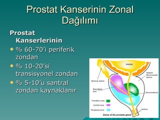 Prostat Kanserinin Zonal Dağılımı Prostat Kanserlerinin % 60-70’i periferik zondan % 10-20’si transisyonel zondan % 5-10’u santral zondan kaynaklanır 