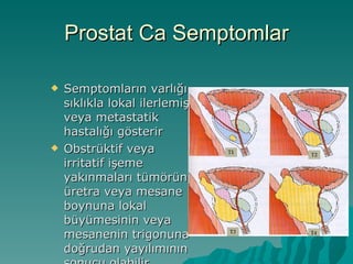 Prostat Ca Semptomlar Semptomların varlığı sıklıkla lokal ilerlemiş veya metastatik hastalığı gösterir Obstrüktif veya irritatif işeme yakınmaları tümörün üretra veya mesane boynuna lokal büyümesinin veya mesanenin trigonuna doğrudan yayılımının sonucu olabilir 