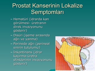 Prostat Kanserinin Lokalize Semptomları Hematüri (idrarda kan görülmesi- üretranın direk invazyonunu gösterir) Disüri (işeme sırasında ağrı ve yanma) Perinede ağrı (perineal sinirin tutulumu) İnkontinans (idrar kaçırma-üretra sfinkterinin invazyonunu gösterir) 