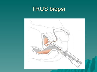TRUS biopsi 