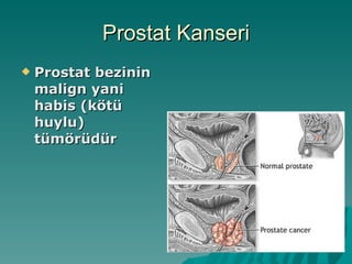 Prostat Kanseri Prostat bezinin malign yani habis (kötü huylu) tümörüdür 