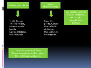 Nódulos glandulares

Tejido de color
amarillo-rosado,
con consitencia
blanda.
Líquido prostático
blanco lechoso

Nódulos
fibromusculares

Color gris
pálido, fuertes,
sin exudación
de líquido.
Menos clara la
delimitación.

Los nódulos varian: Nódulos
fibromusculares estromales; nódulos
fibroepiteliales glandulares.

Los nódulos no tienen
cápsula verdadera,
pero el tejido
circundante los
delimita.

 