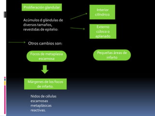 Proliferación glandular
Acúmulos d glándulas de
diversos tamaños,
revestidas de epitelio:

Interior
cilíndrico
Externo
cúbico o
aplanado

Otros cambios son:
Focos de metaplasia
escamosa

Márgenes de los focos
de infarto.
Nidos de células
escamosas
metaplásicas
reactivas.

Pequeñas áreas de
infarto

 