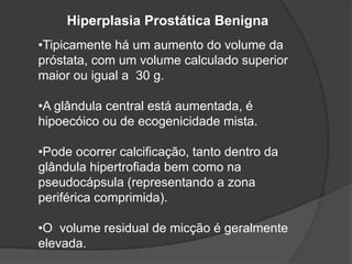 Hiperplasia Prostática Benigna
•Tipicamente há um aumento do volume da
próstata, com um volume calculado superior
maior ou igual a 30 g.
•A glândula central está aumentada, é
hipoecóico ou de ecogenicidade mista.
•Pode ocorrer calcificação, tanto dentro da
glândula hipertrofiada bem como na
pseudocápsula (representando a zona
periférica comprimida).
•O volume residual de micção é geralmente
elevada.
 