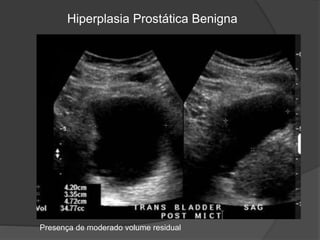 Hiperplasia Prostática Benigna
Presença de moderado volume residual
 