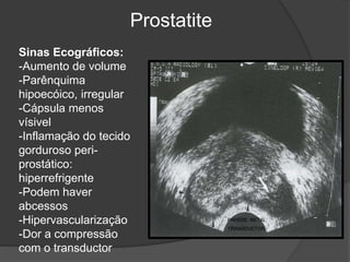 PAREDE RETAL
TRANSDUCTOR
Prostatite
Sinas Ecográficos:
-Aumento de volume
-Parênquima
hipoecóico, irregular
-Cápsula menos
vísivel
-Inflamação do tecido
gorduroso peri-
prostático:
hiperrefrigente
-Podem haver
abcessos
-Hipervascularização
-Dor a compressão
com o transductor
 