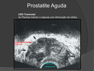 Prostatite Aguda
VEJIGA
PAREDE RETAL
TRANSDUTOR
Gordura peri-prostática
inflamada
USG Transretal
As Flechas indicam a cápsula com diminuição da nitidez
 