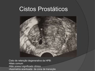 Cistos Prostáticos
Cisto de retenção degenerativa da HPB:
•Mais comum
•Não possui significado clínico
•Assimetria acentuada da zona de transição
 