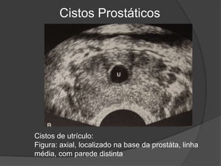 Cistos Prostáticos
Cistos de utrículo:
Figura: axial, localizado na base da prostáta, linha
média, com parede distinta
 