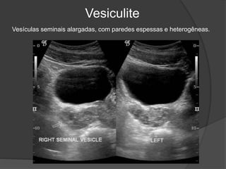 Vesiculite
Vesículas seminais alargadas, com paredes espessas e heterogêneas.
 