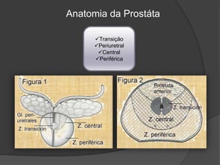 Anatomia da Prostáta
Transição
Periuretral
Central
Periférica
 