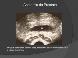 Anatomia da Prostáta
Imagem transversal sobre a base, mostrando as vesículas seminais e
e vasos deferentes
 