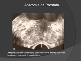 Anatomia da Prostáta
Imagem axial em nível médio. Esfíncter uretral interno muscular
hipoecóico e os ductos ejaculatórios.
 