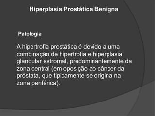 Hiperplasia Prostática Benigna
Patologia
A hipertrofia prostática é devido a uma
combinação de hipertrofia e hiperplasia
glandular estromal, predominantemente da
zona central (em oposição ao câncer da
próstata, que tipicamente se origina na
zona periférica).
 