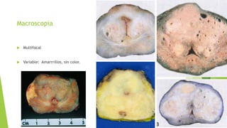 Macroscopia
 Multifocal
 Variable: Amarrrillos, sin color.
 