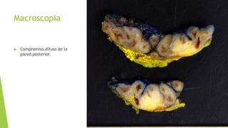 Macroscopia
 Compromiso difuso de la
pared posterior.
 