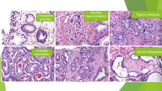 Citoplasma
amfofilo
Núcleos
hipercromático
s
Figuras mitóticas
Cristales
eosinófilos
Mucina fibroplasia
 