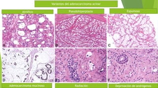 Atrófico Pseudohiperplasia
RadiaciónAdenocarcinoma mucinoso
Espumoso
Deprivación de andrógenos
Variantes del adenocarcinoma acinar
 