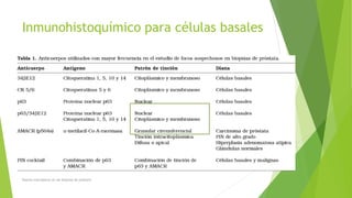 Inmunohistoquímico para células basales
Nuevos marcadores en las biopsias de próstata
 