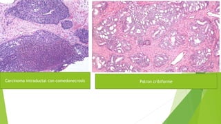 Carcinoma intraductal con comedonecrosis Patron cribiforme
 