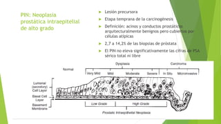 PIN: Neoplasia
prostática intraepitelial
de alto grado
 Lesión precursora
 Etapa temprana de la carcinogénesis
 Definición: acinos y conductos prostáticos
arquitecturalmente benignos pero cubiertos por
células atípicas
 2,7 a 14,2% de las biopsias de próstata
 El PIN no eleva significativamente las cifras de PSA
sérico total ni libre
 