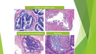 Células en anillo de sello
Célula pequeña neuroendocrino Mucinosa
 