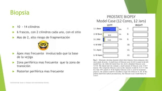 Biopsia
 10 - 14 cilindros
 6 frascos, con 2 cilindros cada uno, con el sitio
 Mas de 2, alto riesgo de fragmentación
 Ápex mas frecuente involucrado que la base
de la vejiga
 Zona periférica mas frecuente que la zona de
transición
 Posterior periférica mas frecuente
Controversial issues in Gleason and International Society
 