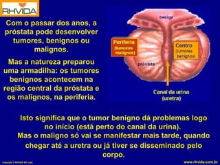 Com o passar dos anos, a próstata pode desenvolver tumores, benignos ou malignos. Mas a natureza preparou uma armadilha: os tumores benignos acontecem na região central da próstata e os malignos, na periferia. Isto significa que o tumor benigno dá problemas logo no início (está perto do canal da urina).  Mas o maligno só vai se manifestar mais tarde, quando chegar até a uretra ou já tiver se disseminado   pelo corpo. 