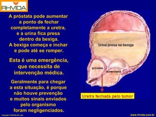A próstata pode aumentar  a ponto de fechar completamente a uretra,  e a urina fica presa  dentro da bexiga. A bexiga começa e inchar  e pode até se romper. Esta é uma emergência, que necessita de intervenção médica. Geralmente para chegar  a esta situação, é porque  não houve prevenção  e muitos sinais enviados  pelo organismo  foram negligenciados . 