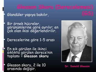 

Gleason Skoru (Derecelemesi)
(GS)
Glandüler yapıya bakılır,

 Bir örnek hücreler,

görünümlerine göre ayrılır; en
çok olan ikisi değerlendirilir.

 Derecelerine göre 1-5 arası
 En sık görülen ile ikinci

sıklıkta görülen derece’nin
toplamı = Gleason skoru

 Gleason skoru, 2 ile 10

arasında değişir.

Dr. Donald Gleason

 