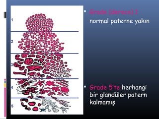  Grade (derece) 1

normal paterne yakın

 Grade 5’te herhangi

bir glandüler patern
kalmamış

 