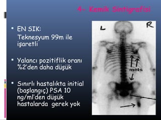 4- Kemik Sintigrafisi
 EN SIK:

Teknesyum 99m ile
işaretli

 Yalancı pozitiflik oranı

%2’den daha düşük

 Sınırlı hastalıkta initial

(başlangıç) PSA 10
ng/ml’den düşük
hastalarda gerek yok

 