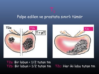 T2

Palpe edilen ve prostata sınırlı tümör
T2b

T2a: Bir lobun < 1/2 tutan tm
T2b: Bir lobun > 1/2 tutan tm

T2b

T2c

T2c: Her iki lobu tutan tm

 