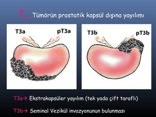 T3:

Tümörün prostatik kapsül dışına yayılımı

T3a Ekstrakapsüler yayılım (tek yada çift taraflı)
T3b Seminal Vezikül invazyonunun bulunması

 