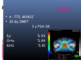 IMRT
 n : 772, MSKCC
 81 Gy IMRT

3 y PSA SK
İyi
Orta
Kötü

% 93
% 84
% 81

 