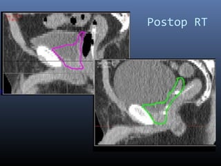 Postop RT

 