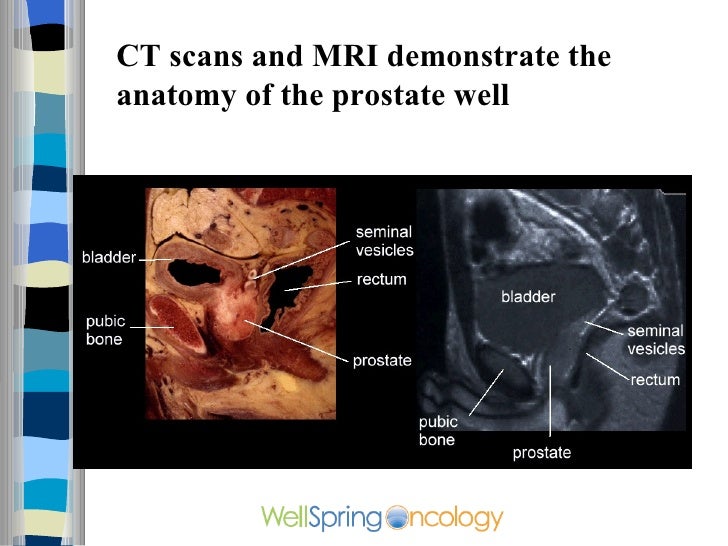 Can A Cat Scan Detect Prostate Cancer Can A Cat Scan Detect Prostate Cancer
