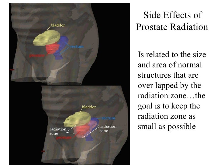 Prostate Cancer