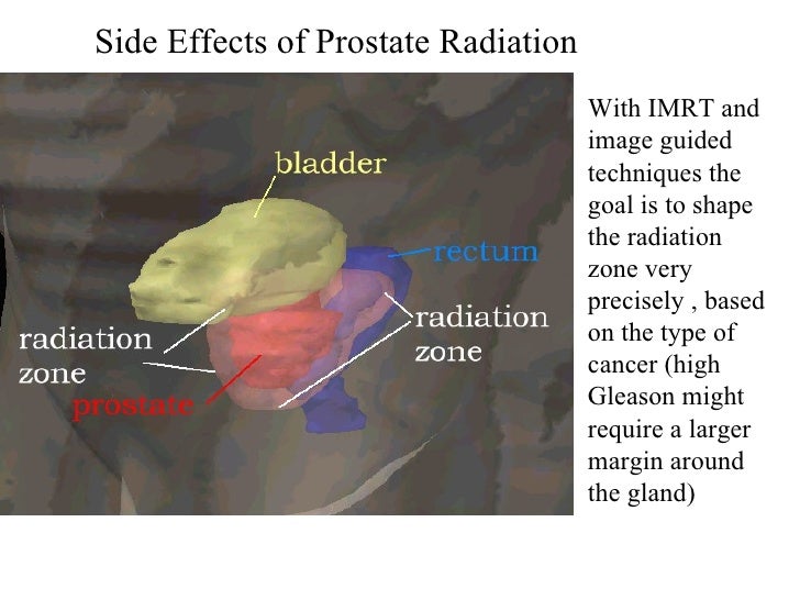 What are some side effects of prostrate radiation?