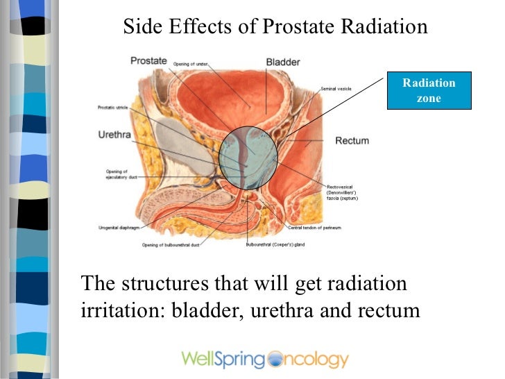 Prostate cancer radiation therapy: treatment and side effects