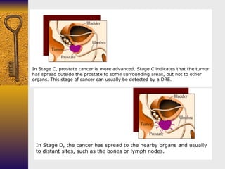                                                                 In Stage C, prostate cancer is more advanced. Stage C indi...