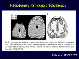 Fullar et al, IJROBP 2008
Radiosurgery mimicking brachytherapy
 