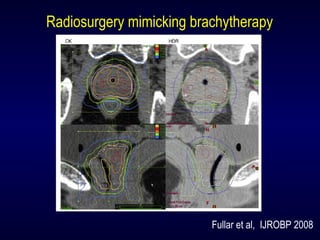 Fullar et al, IJROBP 2008
Radiosurgery mimicking brachytherapy
 