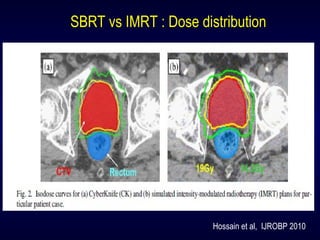 Hossain et al, IJROBP 2010
SBRT vs IMRT : Dose distribution
 